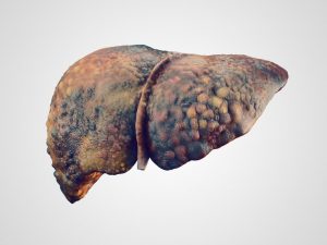 Liver Disease Due To Alcoholism